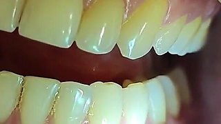 Complete Teeth Exam by the Dentist, Installation of Jewelry