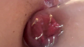 Light suction of rectum with piercing